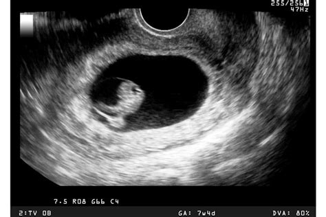 pregnancy dating scan due date